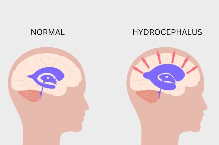 Hydrocephalus treatment in India for African patients