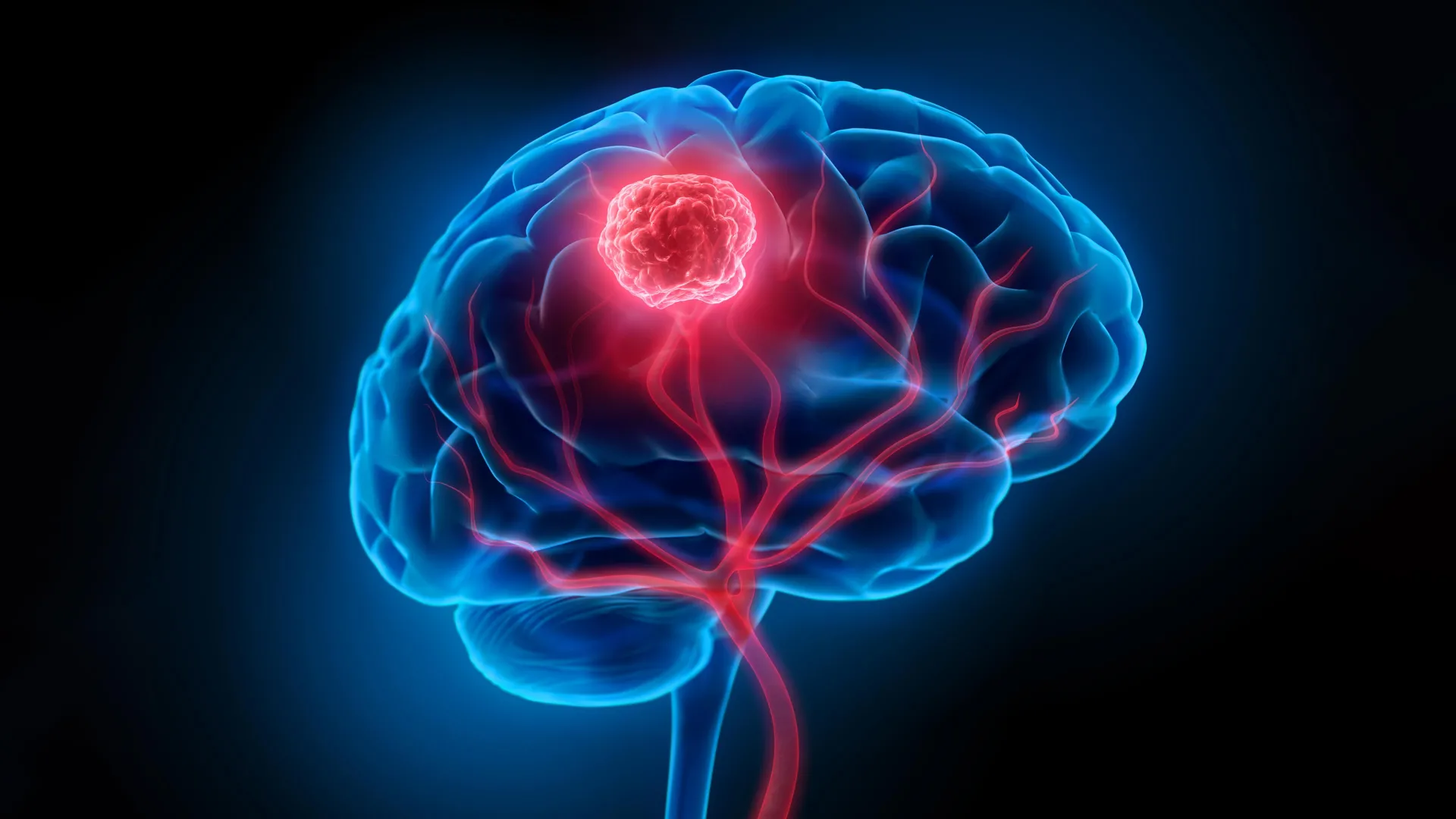 Brain Tumors treatment in India for African patients